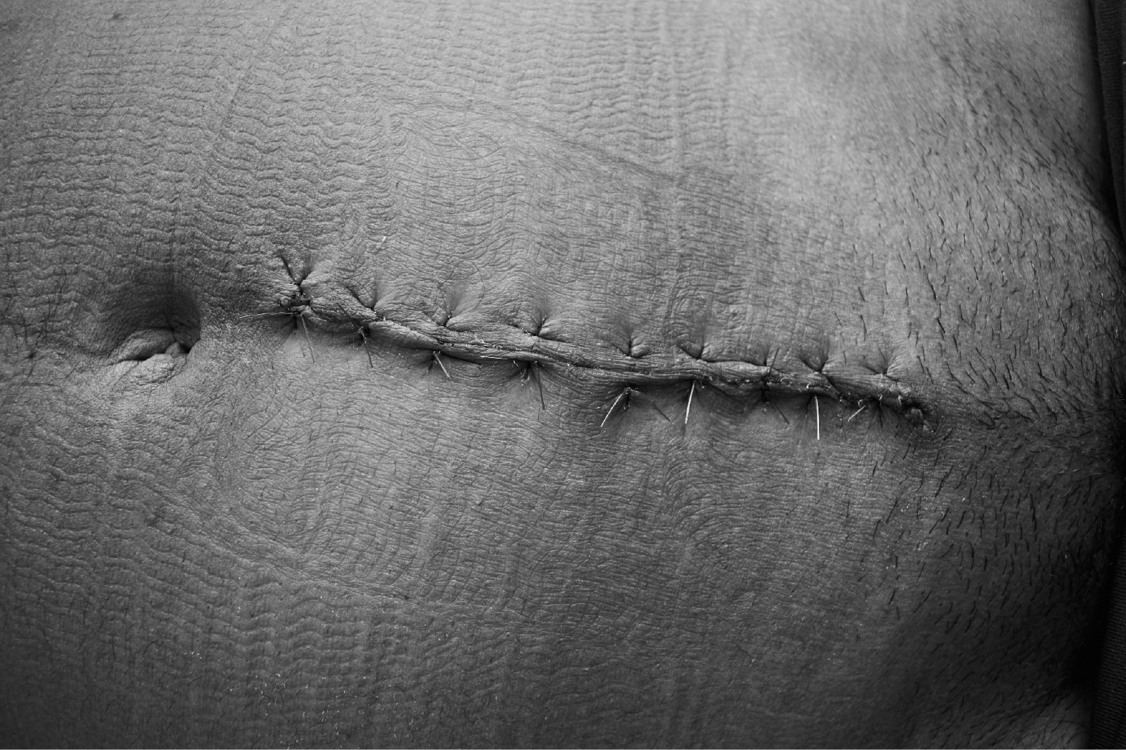 Marked forever Cesarean scar - Photography by Juana Pola